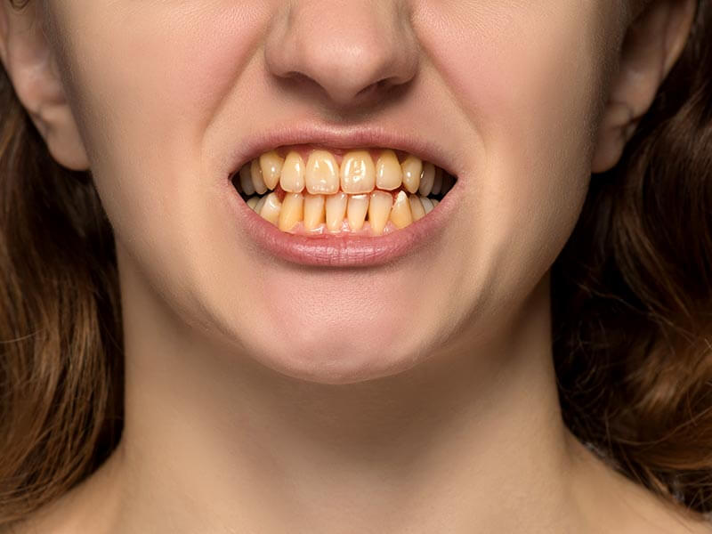 diş sararmasının nedenleri, dişlerimiz neden sararır, diş sararması, diş tedavisi, eskişehir diş hekimi